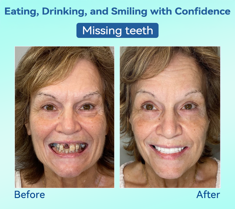 🌎Ends Today: 70% OFF!⏰Tiworld® Premium Denture🍀AdaptableFit Functional Dentures🦷Obtain American Dental Association (ADA) Certification