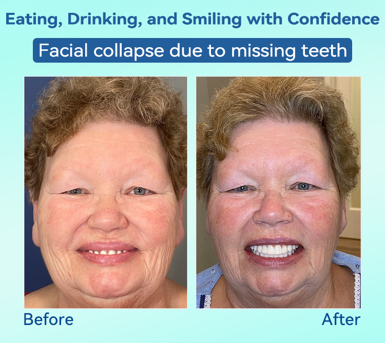 🌎Ends Today: 70% OFF!⏰Tiworld® Premium Denture🍀AdaptableFit Functional Dentures🦷Obtain American Dental Association (ADA) Certification